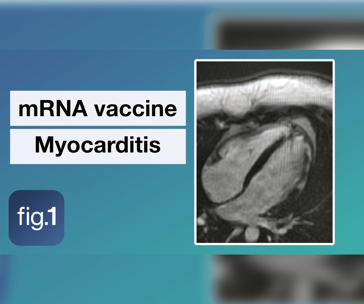 Claims of mRNA vaccine-induced myocarditis in young males were dismissed as 'misinformation' before being confirmed by the CDC — documented evidence