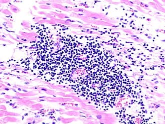Claims of mRNA vaccine-induced myocarditis in young males were dismissed as 'misinformation' before being confirmed by the CDC — documented evidence